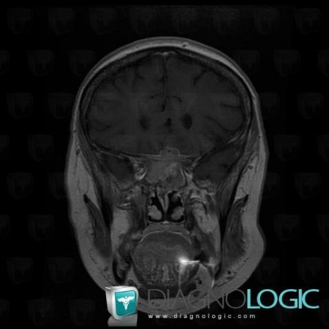 Radiology case : Metastasis (MRI) - Diagnologic