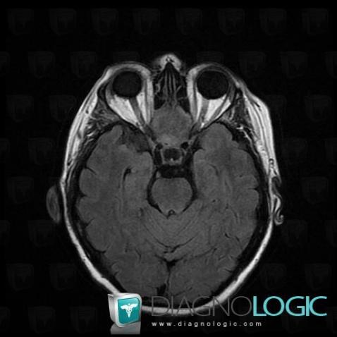 Radiology case : Metastasis (MRI) - Diagnologic