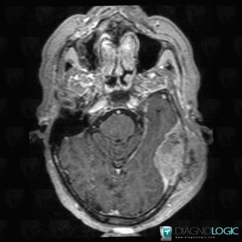 Metastasis, Skull vault, MRI