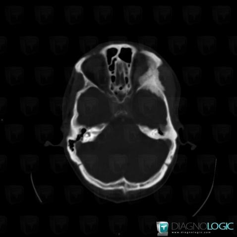 Metastasis, Skull vault, Orbital bones, CT