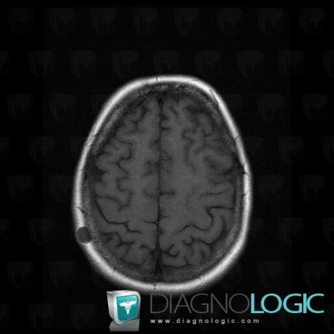 Metastasis, Soft tissues - Skull, MRI