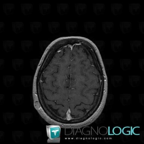 Metastasis, Soft tissues - Skull, MRI