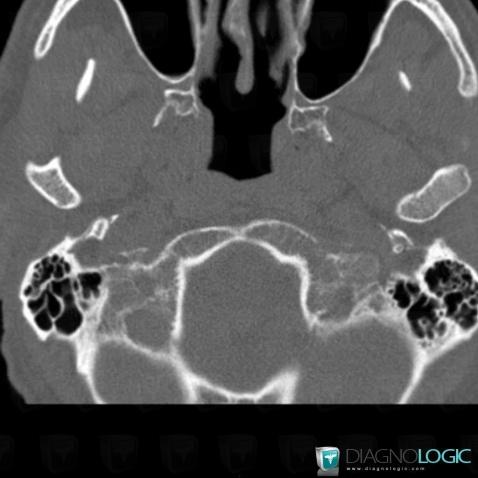 Metastasis, Sphenoid bone, CT