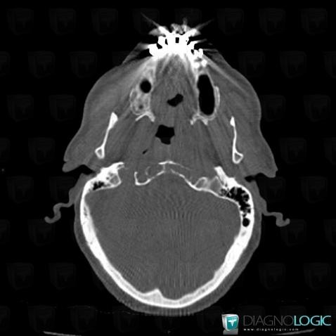 Metastasis, Sphenoid bone, CT