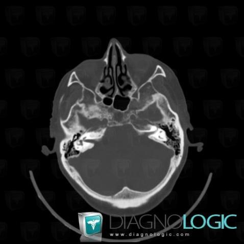 Metastasis, Sphenoid bone, CT