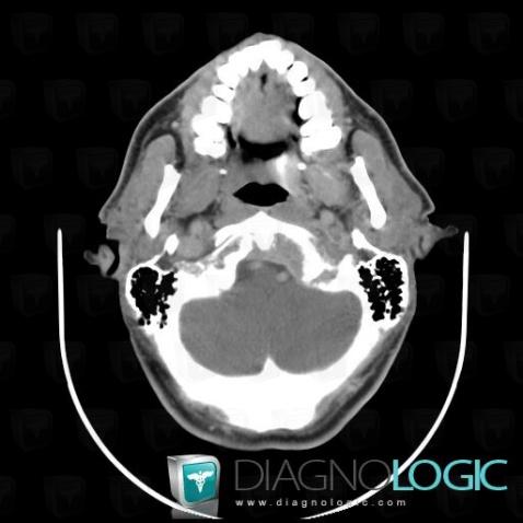 Metastasis, Sphenoid bone, CT