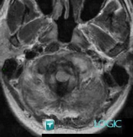 Metastasis, Sphenoid bone, MRI