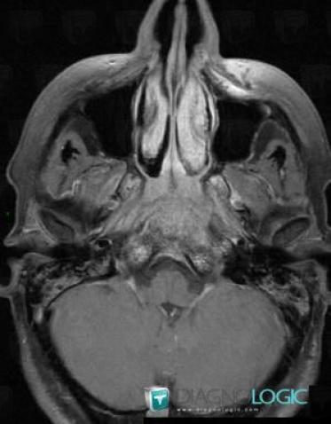 Metastasis, Sphenoid bone, MRI