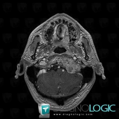 Metastasis, Sphenoid bone, MRI