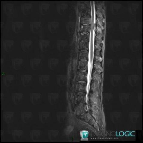 Metastasis, Spinal canal / Cord, MRI