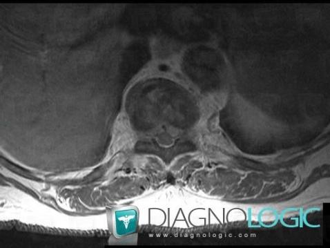 Metastasis, Spinal canal / Cord, MRI