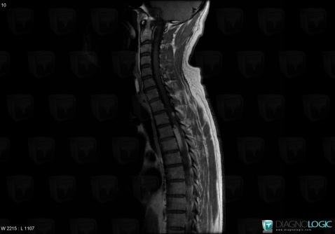 Metastasis, Spinal canal / Cord, MRI