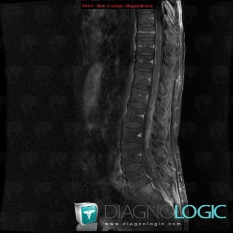 Metastasis, Spinal canal / Cord, MRI