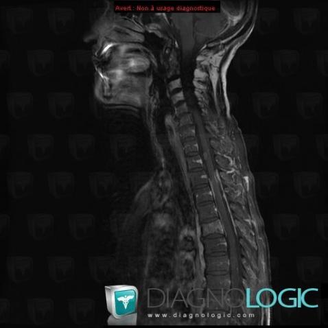 Metastasis, Spinal canal / Cord, MRI