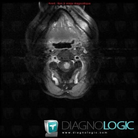 Metastasis, Spinal canal / Cord, MRI