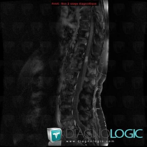 Metastasis, Spinal canal / Cord, MRI