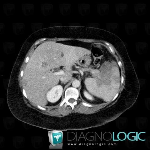 Metastasis, Spleen, CT