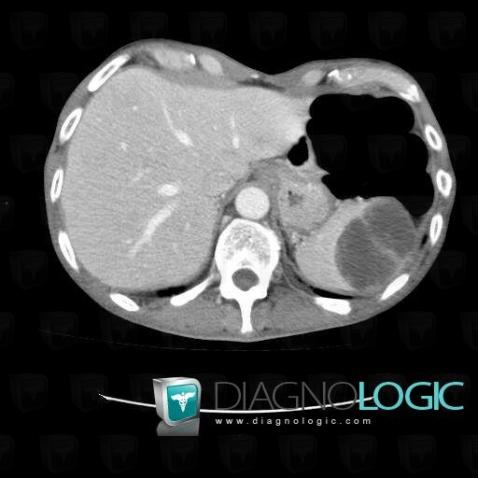 Metastasis, Spleen, CT