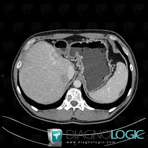 Metastasis, Spleen, CT