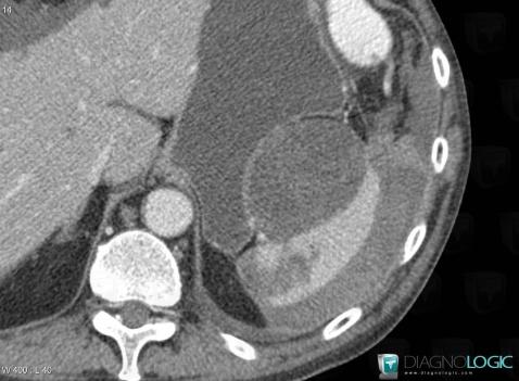 Metastasis, Spleen, CT