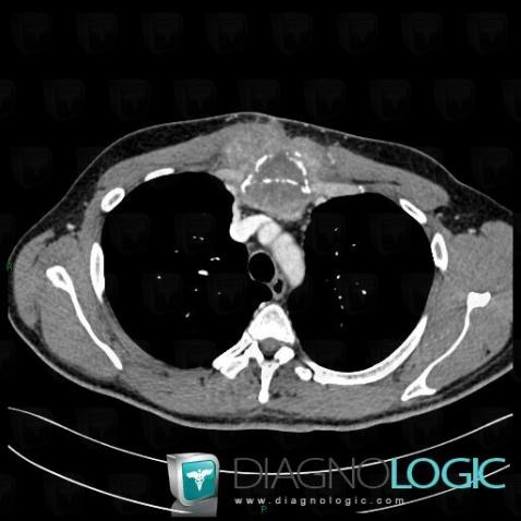 Metastasis, Sternum, CT