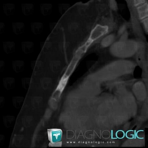Metastasis, Sternum, CT