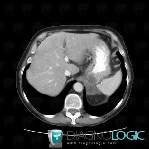 Metastasis, Stomach, CT