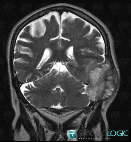 Metastasis, Supratentorial peri cerebral spaces, Infratentorial peri cerebral spaces, MRI