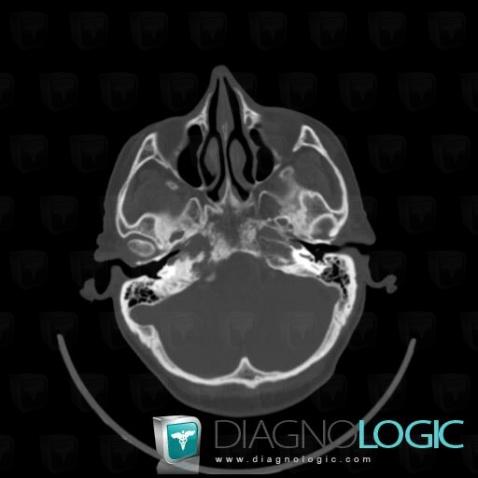 Metastasis, Temporal bone, CT