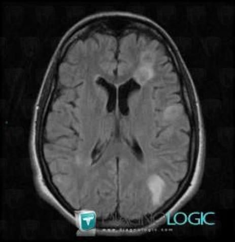 Metastasis, Ventricles / Periventricular region, MRI