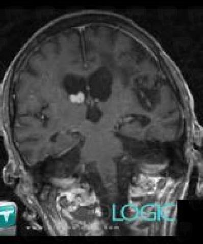 Metastasis, Ventricles / Periventricular region, MRI