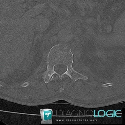 Metastasis, Vertebral body / Disk, CT