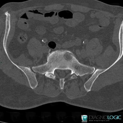Metastasis, Vertebral body / Disk, CT