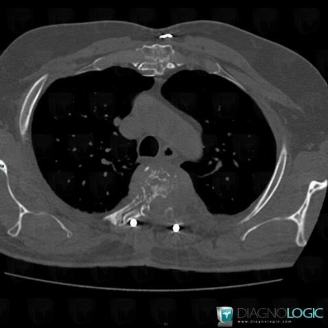 Metastasis, Vertebral body / Disk, CT