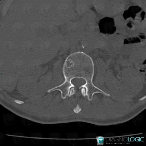 Metastasis, Vertebral body / Disk, CT