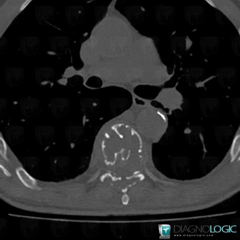 Metastasis, Vertebral body / Disk, CT