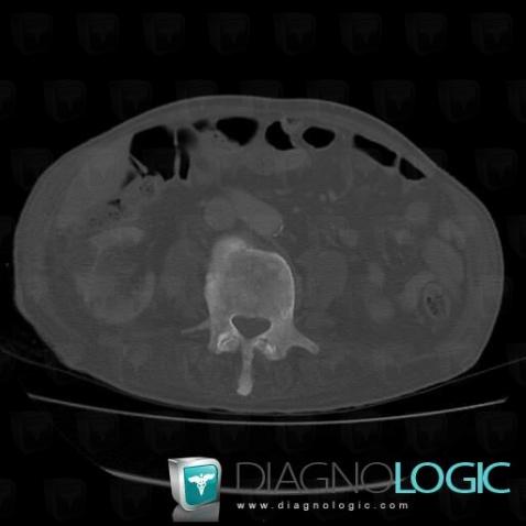 Metastasis, Vertebral body / Disk, CT