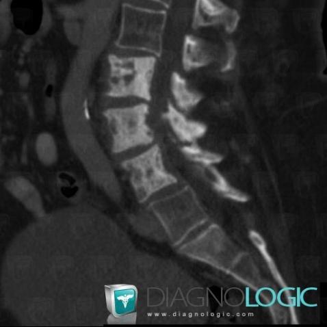 Metastasis, Vertebral body / Disk, CT