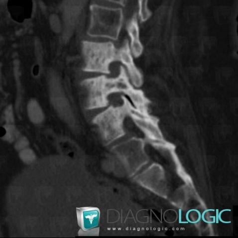 Metastasis, Vertebral body / Disk, CT