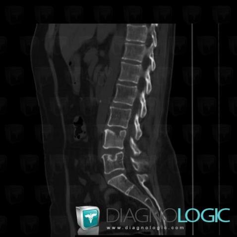 Metastasis, Vertebral body / Disk, CT