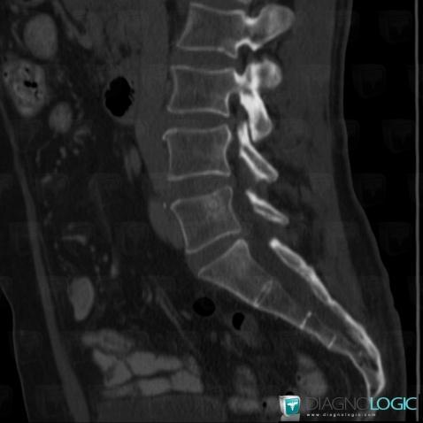 Metastasis, Vertebral body / Disk, CT