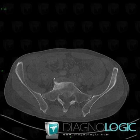 Metastasis, Vertebral body / Disk, CT