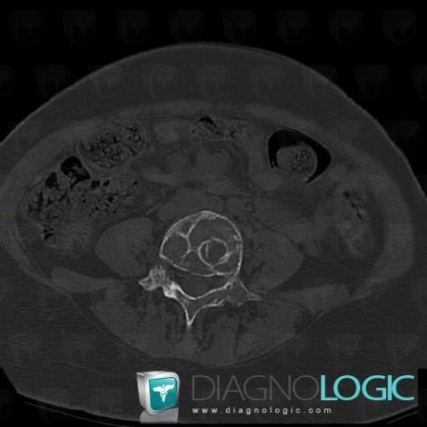 Metastasis, Vertebral body / Disk, CT