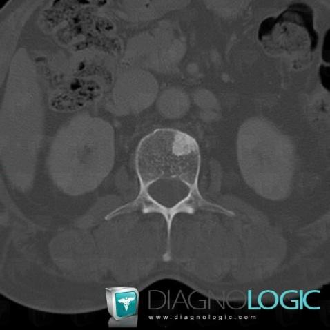 Metastasis, Vertebral body / Disk, CT