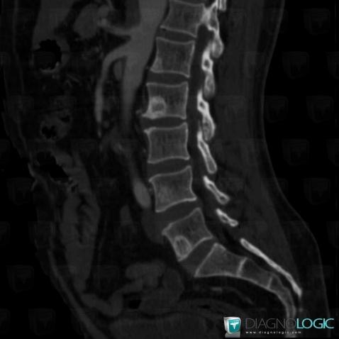 Metastasis, Vertebral body / Disk, CT