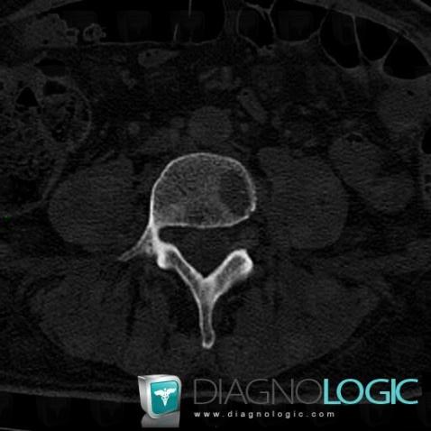 Metastasis, Vertebral body / Disk, CT