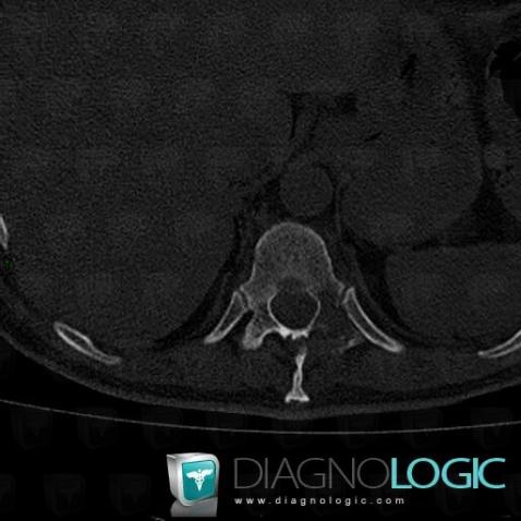 Metastasis, Vertebral body / Disk, CT