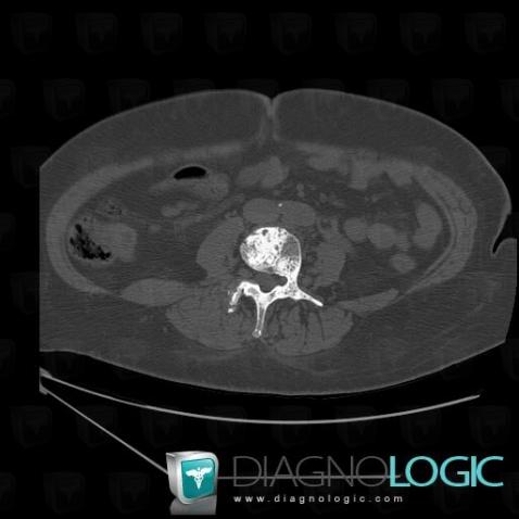 Metastasis, Vertebral body / Disk, CT