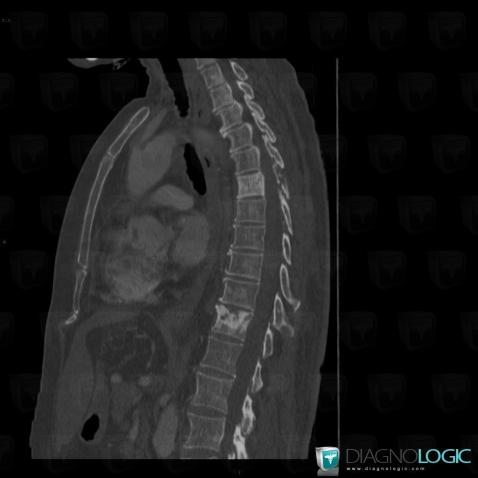 Metastasis, Vertebral body / Disk, CT