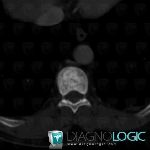 Metastasis, Vertebral body / Disk, CT